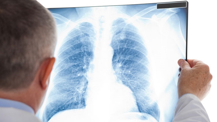 Здорові легені: що їсти для підтримки цього органу